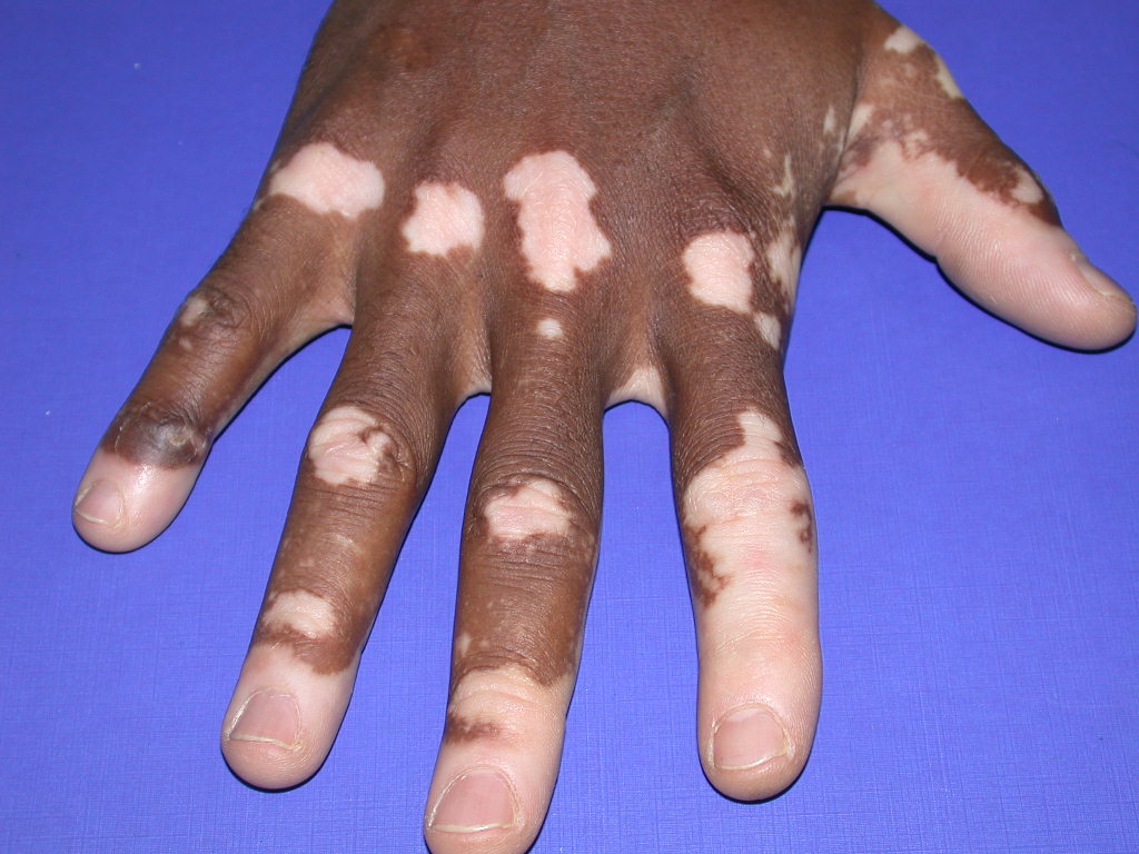 Les taches de pigment sous les yeux de lhomme